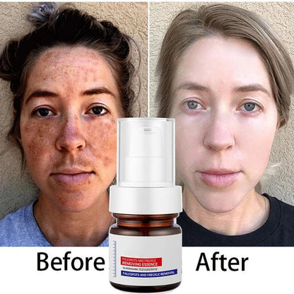 ⚡5-second brightening rescue: Dark spots disappear, blemishes fade, and skin becomes radiant! Vitamin C Whitening Freckles ESSENCE(3 HOURS LEFT!)